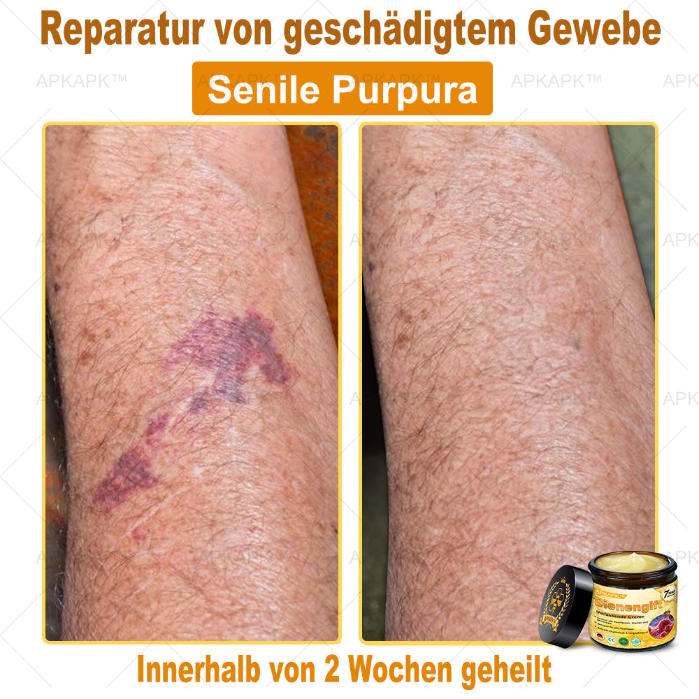 Hergestellt in Deutschland ✨✨AРKAРК™ Bienengift Umfassende Creme – Anti-Aging, Feuchtigkeitsspendend, Hautreparatur, Hautbildverbesserung, Akne- und Pigmentfleckenbehandlung, Warzen- und Muttermalentfernung, Linderung bei Psoriasis