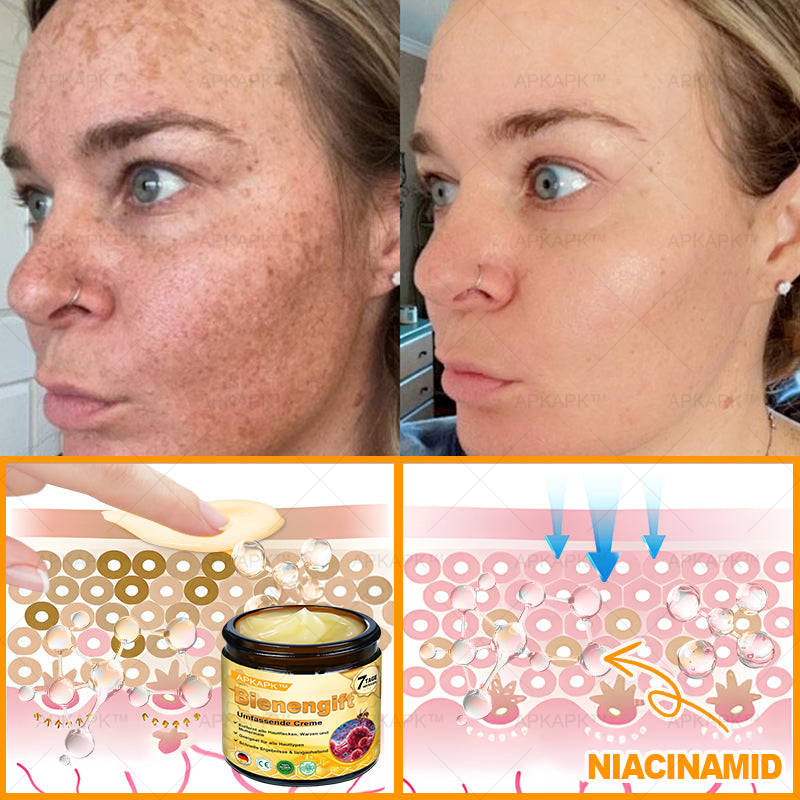 Hergestellt in Deutschland ✨✨AРKAРК™ Bienengift Umfassende Creme – Anti-Aging, Feuchtigkeitsspendend, Hautreparatur, Hautbildverbesserung, Akne- und Pigmentfleckenbehandlung, Warzen- und Muttermalentfernung, Linderung bei Psoriasis