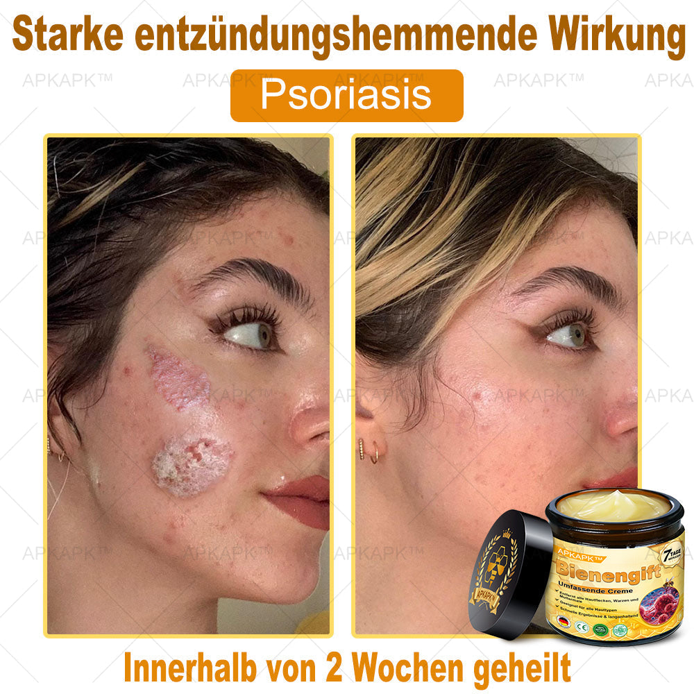 Hergestellt in Deutschland ✨✨AРKAРК™ Bienengift Umfassende Creme – Anti-Aging, Feuchtigkeitsspendend, Hautreparatur, Hautbildverbesserung, Akne- und Pigmentfleckenbehandlung, Warzen- und Muttermalentfernung, Linderung bei Psoriasis