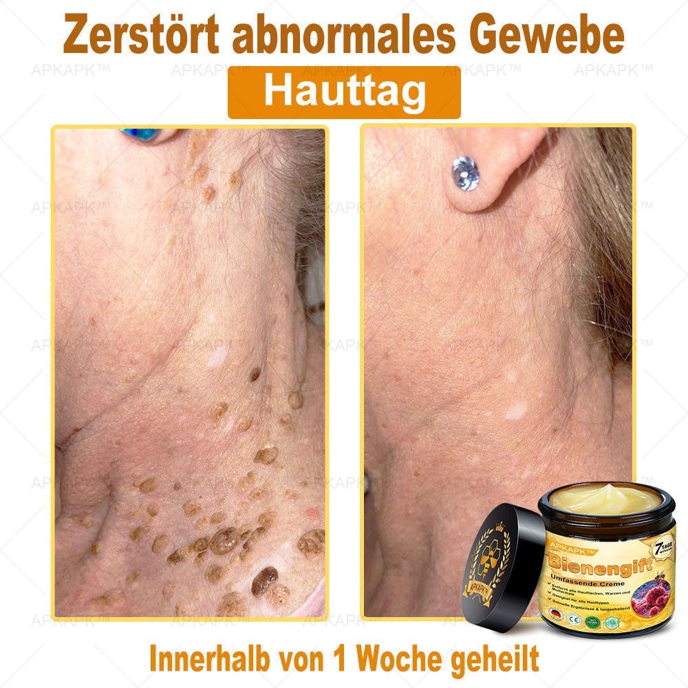 Hergestellt in Deutschland ✨✨AРKAРК™ Bienengift Umfassende Creme – Anti-Aging, Feuchtigkeitsspendend, Hautreparatur, Hautbildverbesserung, Akne- und Pigmentfleckenbehandlung, Warzen- und Muttermalentfernung, Linderung bei Psoriasis