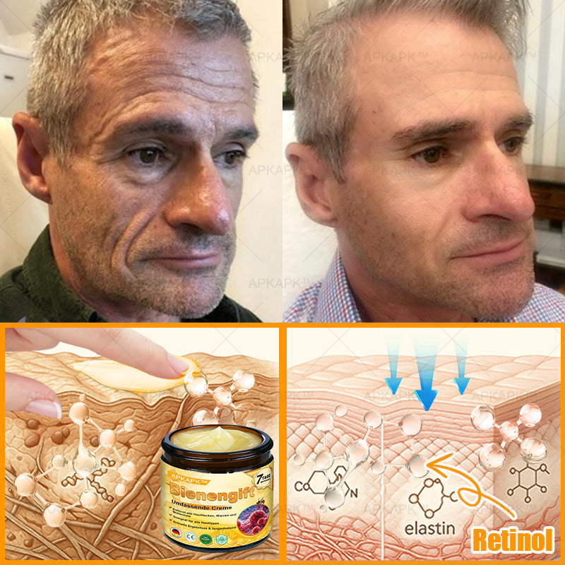 Hergestellt in Deutschland ✨✨AРKAРК™ Bienengift Umfassende Creme – Anti-Aging, Feuchtigkeitsspendend, Hautreparatur, Hautbildverbesserung, Akne- und Pigmentfleckenbehandlung, Warzen- und Muttermalentfernung, Linderung bei Psoriasis