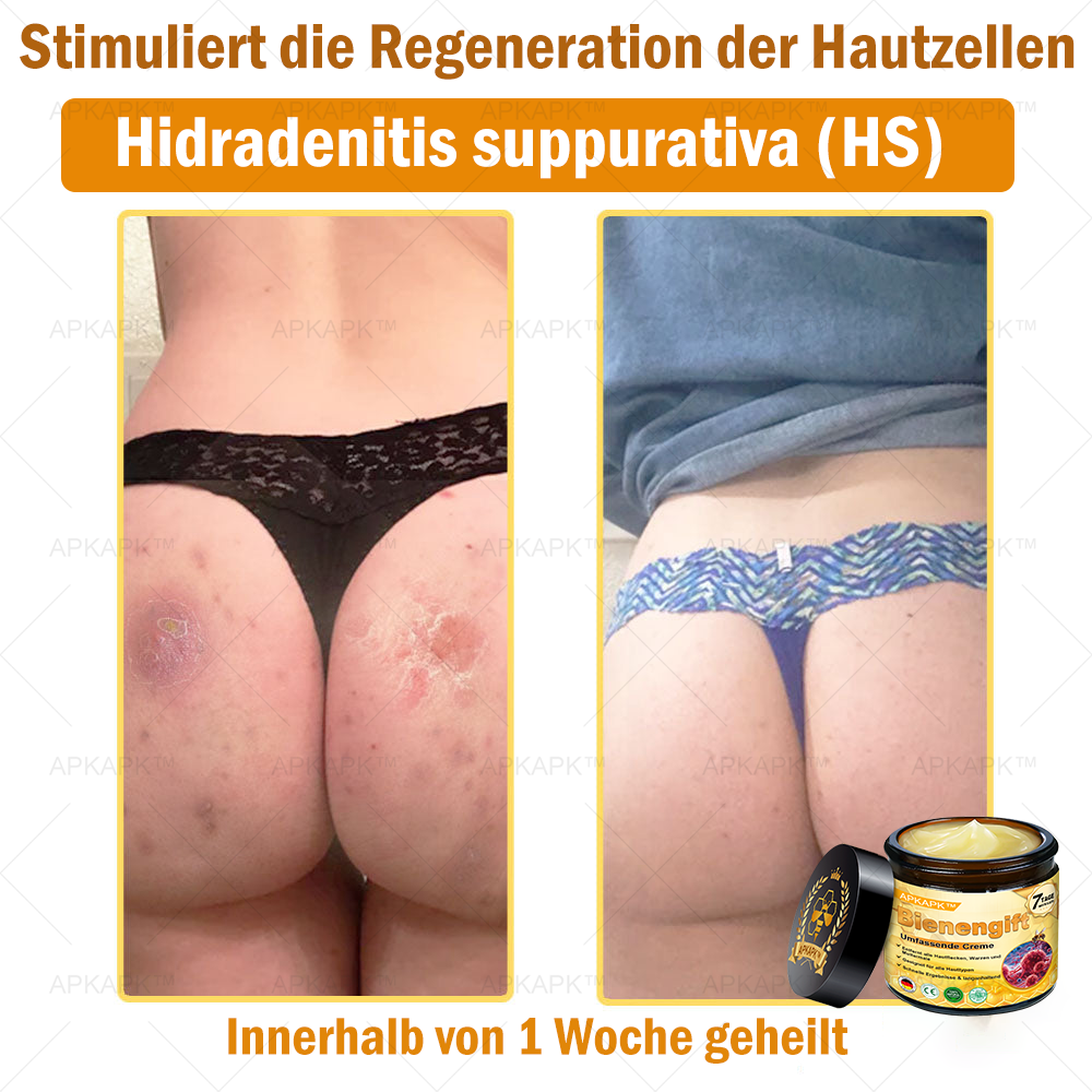Hergestellt in Deutschland ✨✨AРKAРК™ Bienengift Umfassende Creme – Anti-Aging, Feuchtigkeitsspendend, Hautreparatur, Hautbildverbesserung, Akne- und Pigmentfleckenbehandlung, Warzen- und Muttermalentfernung, Linderung bei Psoriasis