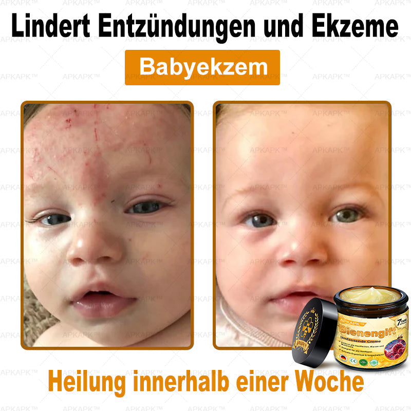 Hergestellt in Deutschland ✨✨AРKAРК™ Bienengift Umfassende Creme – Anti-Aging, Feuchtigkeitsspendend, Hautreparatur, Hautbildverbesserung, Akne- und Pigmentfleckenbehandlung, Warzen- und Muttermalentfernung, Linderung bei Psoriasis