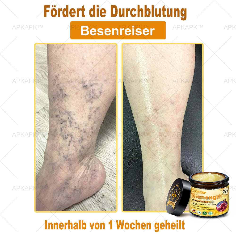 Hergestellt in Deutschland ✨✨AРKAРК™ Bienengift Umfassende Creme – Anti-Aging, Feuchtigkeitsspendend, Hautreparatur, Hautbildverbesserung, Akne- und Pigmentfleckenbehandlung, Warzen- und Muttermalentfernung, Linderung bei Psoriasis