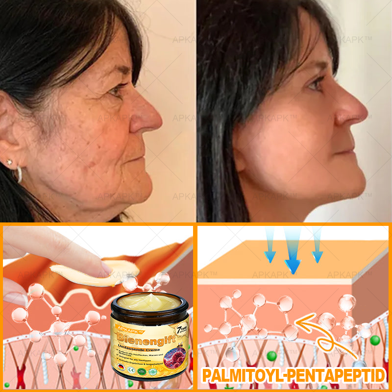 Hergestellt in Deutschland ✨✨AРKAРК™ Bienengift Umfassende Creme – Anti-Aging, Feuchtigkeitsspendend, Hautreparatur, Hautbildverbesserung, Akne- und Pigmentfleckenbehandlung, Warzen- und Muttermalentfernung, Linderung bei Psoriasis