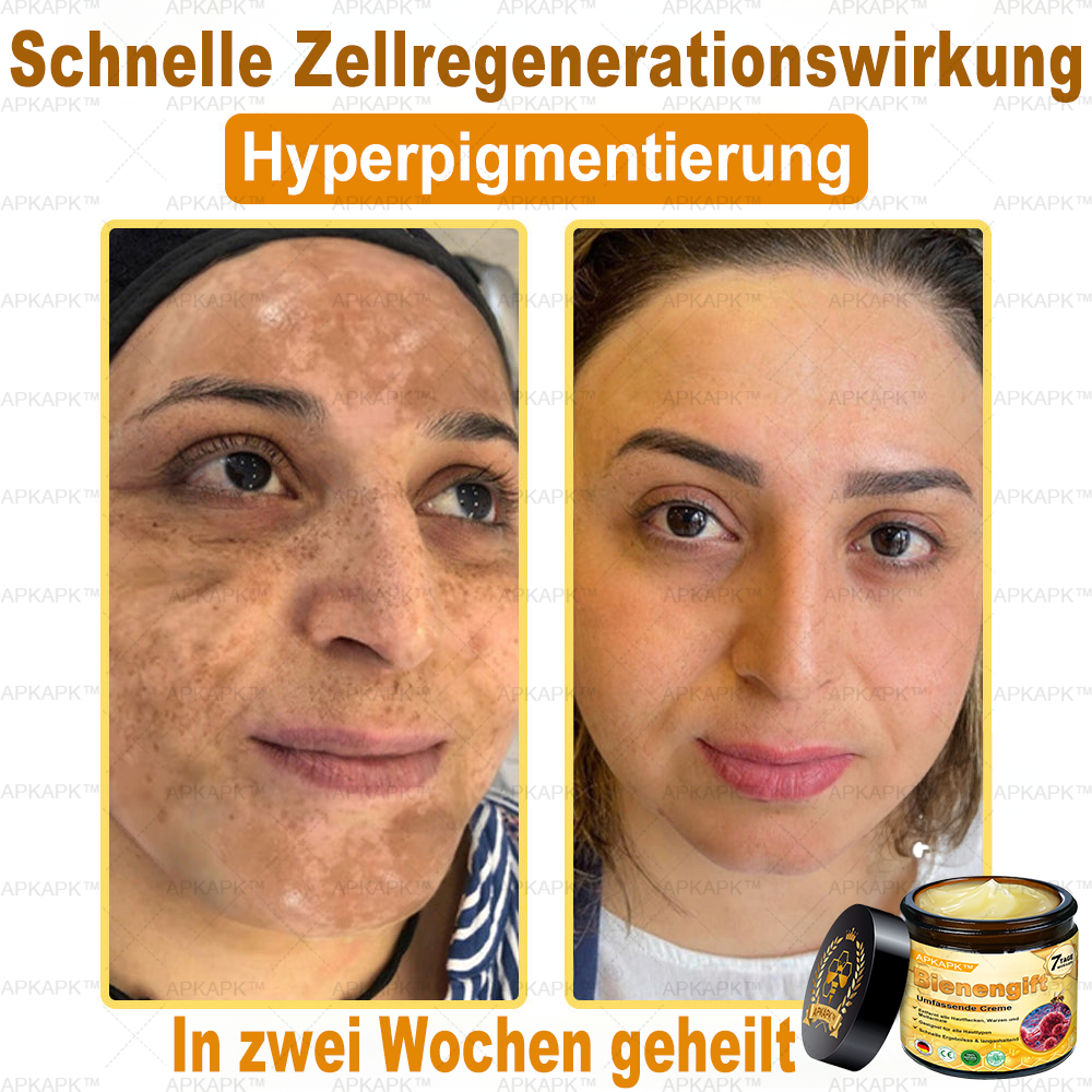 Hergestellt in Deutschland ✨✨AРKAРК™ Bienengift Umfassende Creme – Anti-Aging, Feuchtigkeitsspendend, Hautreparatur, Hautbildverbesserung, Akne- und Pigmentfleckenbehandlung, Warzen- und Muttermalentfernung, Linderung bei Psoriasis