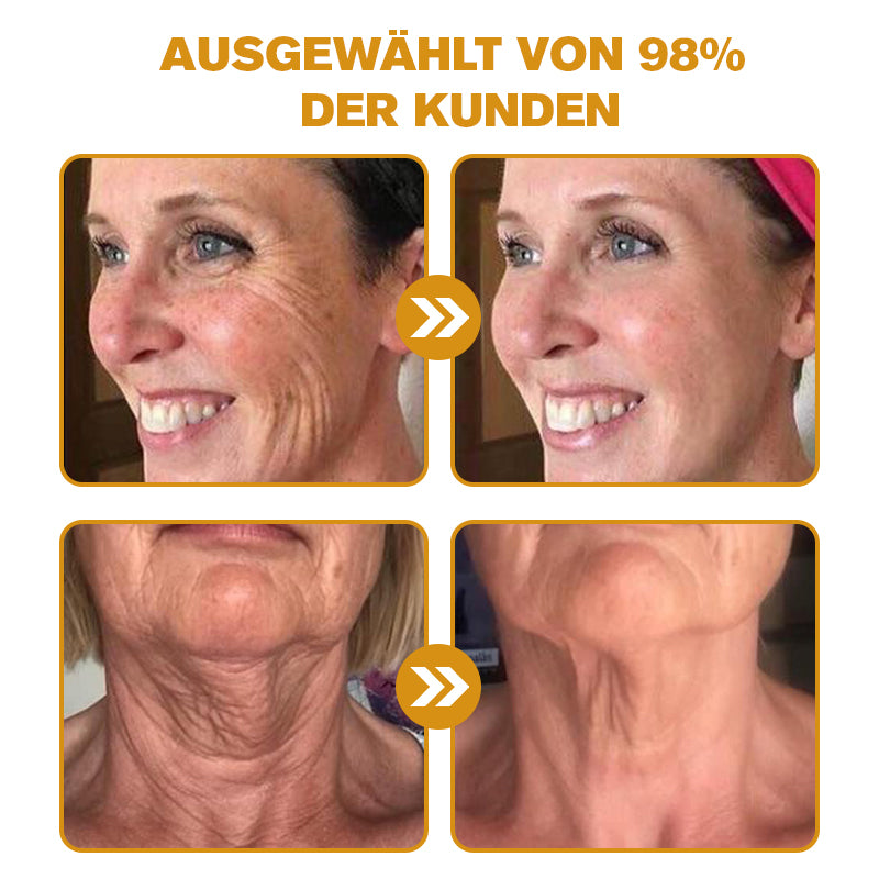 Hergestellt in Deutschland ✨✨AРKAРК™ Bienengift Umfassende Creme – Anti-Aging, Feuchtigkeitsspendend, Hautreparatur, Hautbildverbesserung, Akne- und Pigmentfleckenbehandlung, Warzen- und Muttermalentfernung, Linderung bei Psoriasis