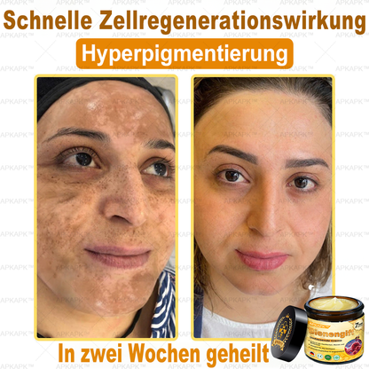 Hergestellt in Deutschland ✨AРKAРК™ Bienengift Umfassende Creme – Anti-Aging, Feuchtigkeitsspendend, Hautreparatur, Hautbildverbesserung, Akne- und Pigmentfleckenbehandlung, Warzen- und Muttermalentfernung, Linderung bei Psoriasis